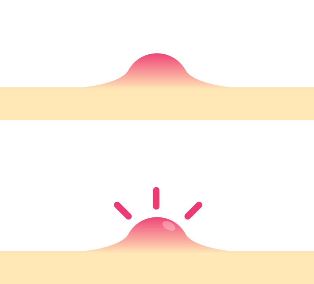 formação da acne na pele