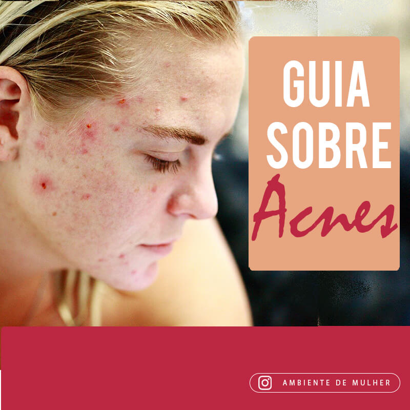 Read more about the article O que causa acnes? Guia para tratamento de acnes