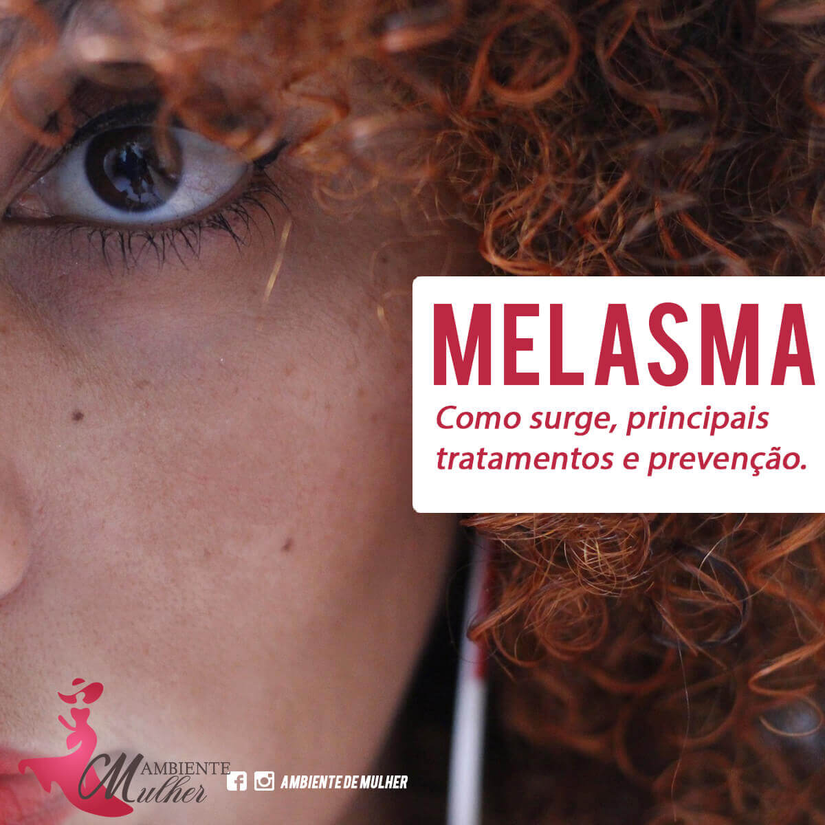 You are currently viewing O que é melasma: Guia com causas e tratamento para melasma